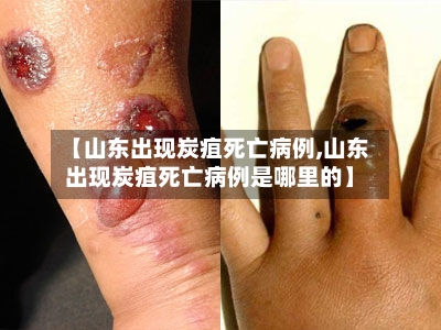 【山东出现炭疽死亡病例,山东出现炭疽死亡病例是哪里的】